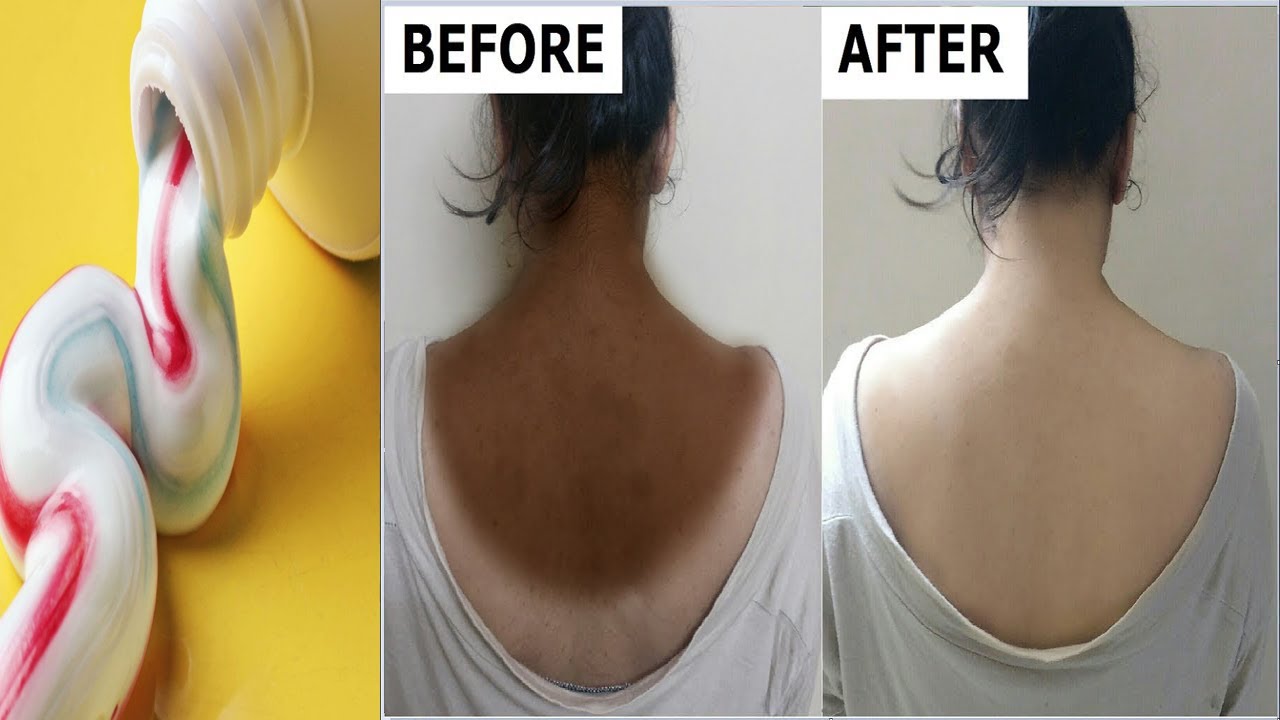 How to Turn Your Dark Neck Into White Fast Naturally In 3 Minutes Dark Neck Solution at home
