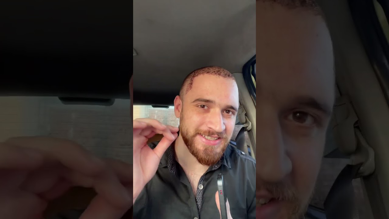 Hair Transplant Final Review #wasifnisar