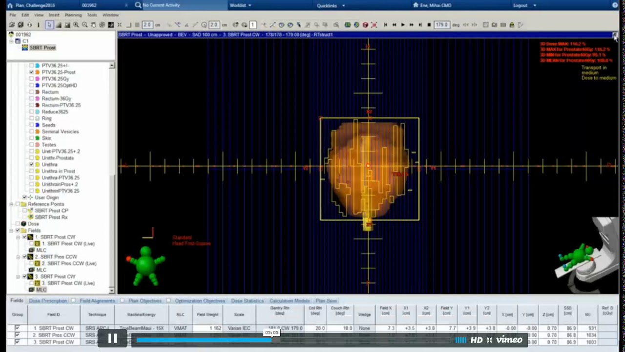 SBRT for Prostate Cancer for Eclipse User