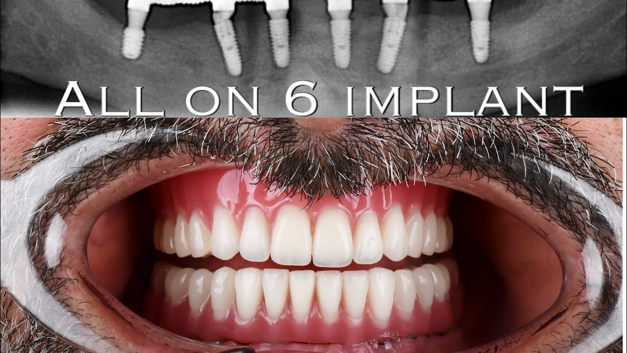 İmplant hibrit protez (all on 6 implant)