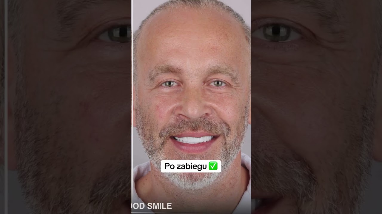 Moja metamorfoza w Turcji 🇹🇷 #metamorfoza #uśmiech #stomatologia #hollywoodsmile #zęby