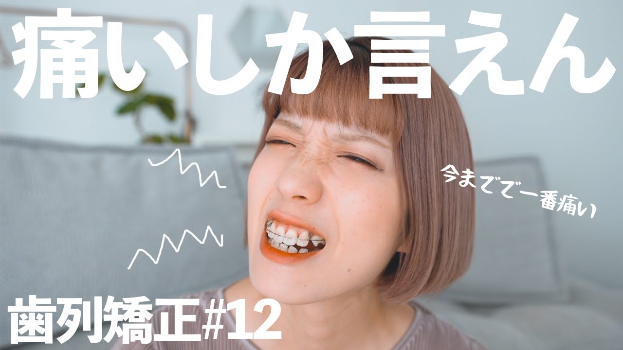 【歯列矯正】１年2ヶ月！矯正史上最大の痛みに泣いた。【抜歯表側ワイヤー矯正】