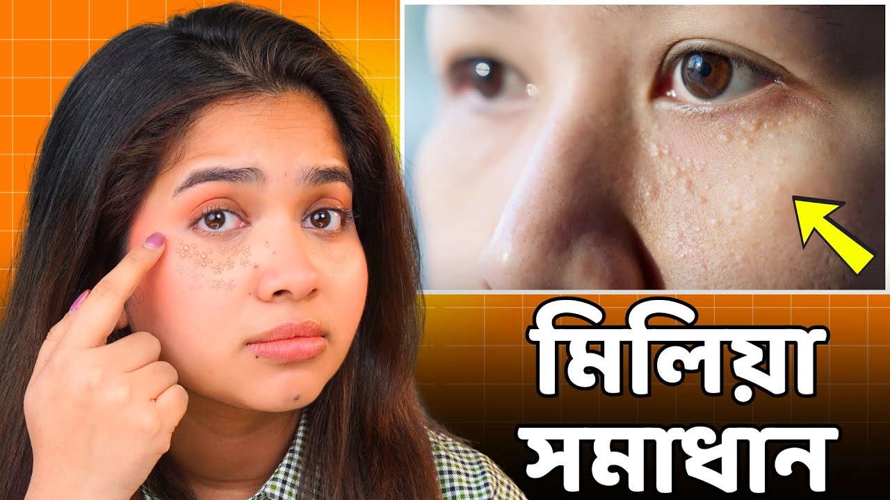 মিলিয়া কি, কেন হয়, কিভাবে দূর করবেন? How to Treat Milia at Home?