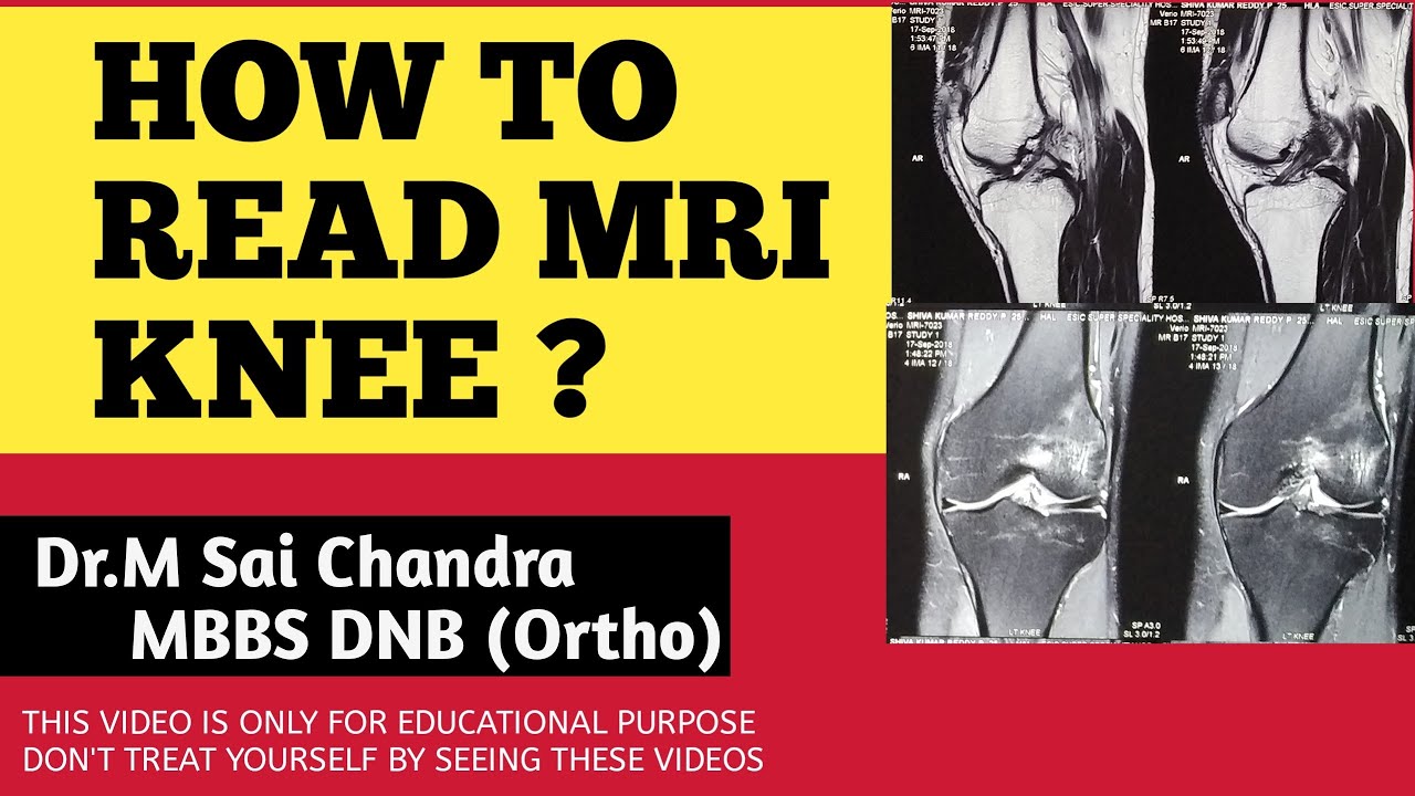 HOW TO READ MRI KNEE ?