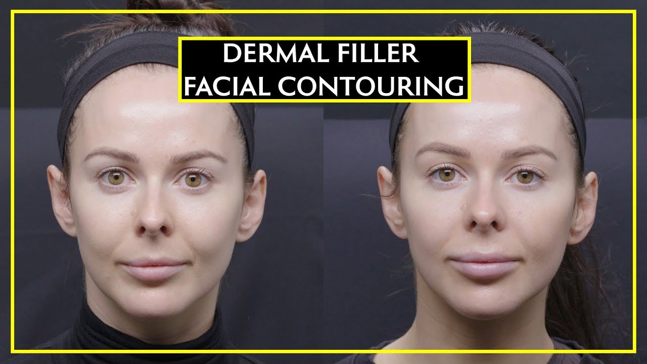 All About Facial Contouring With Dermal Fillers