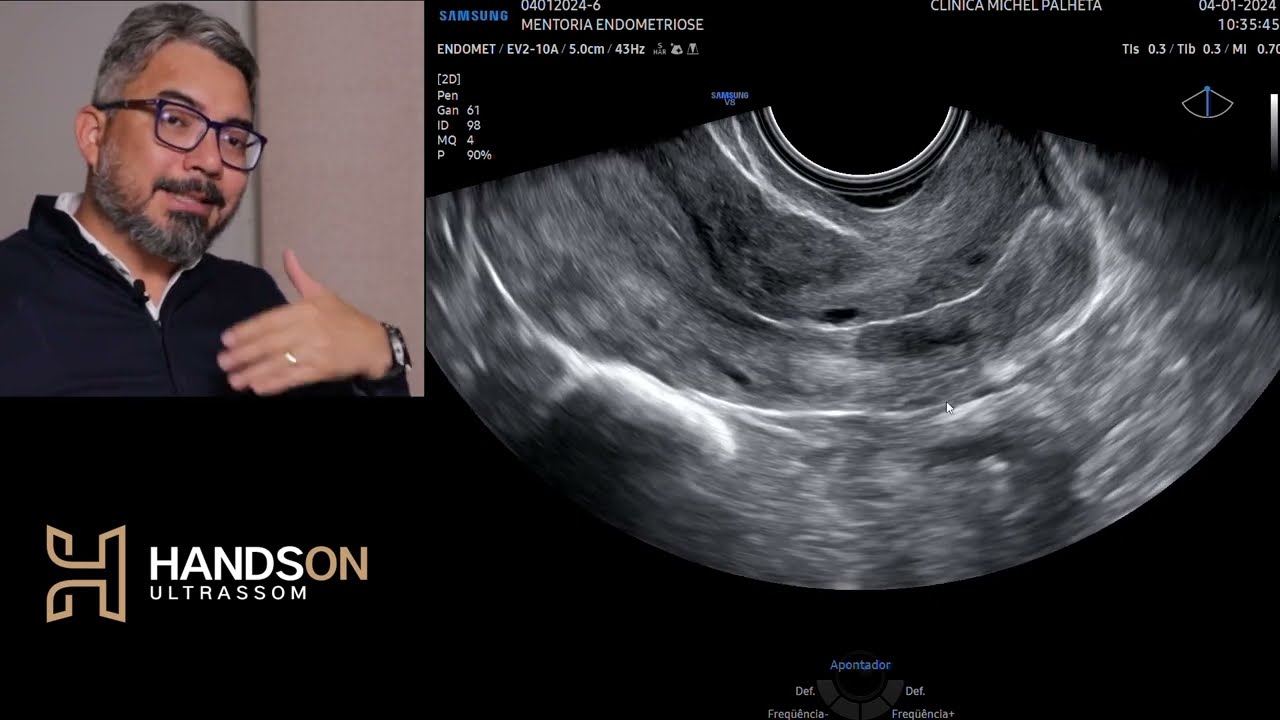 Aula de demonstração prática ultrassom transvaginal para pesquisa de endometriose