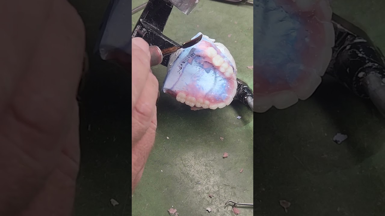 overdenture setup