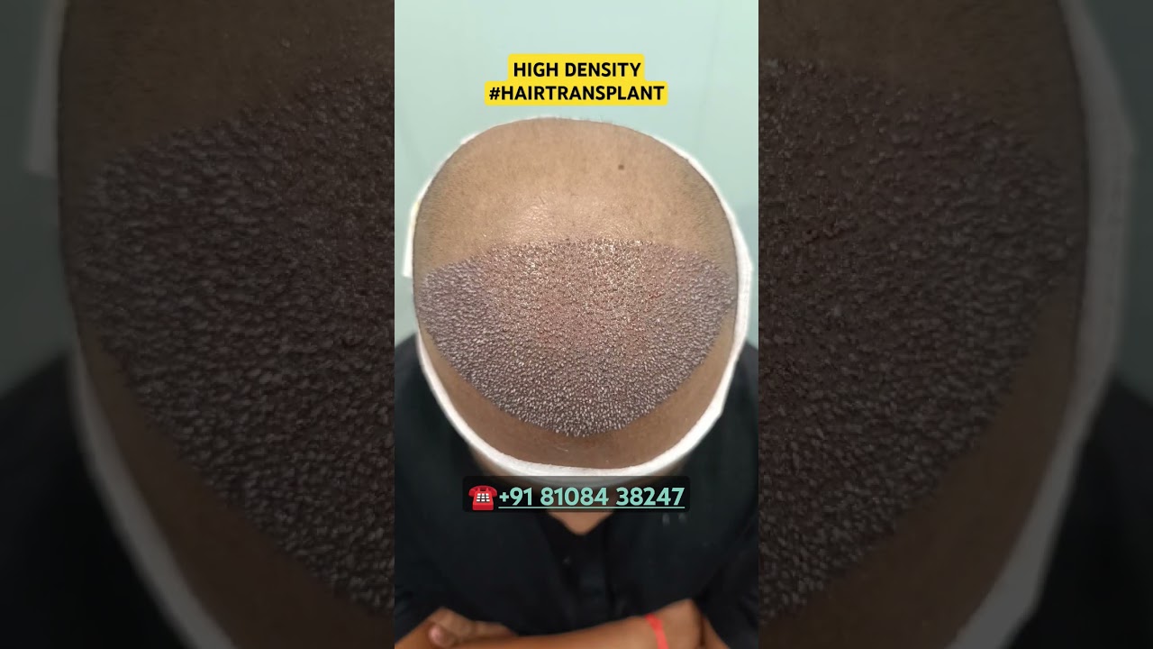 Hair Loss Treatment #hair #hairloss #hairlosstreatment #ytshorts #alopecia #hairtransplant #hairfall