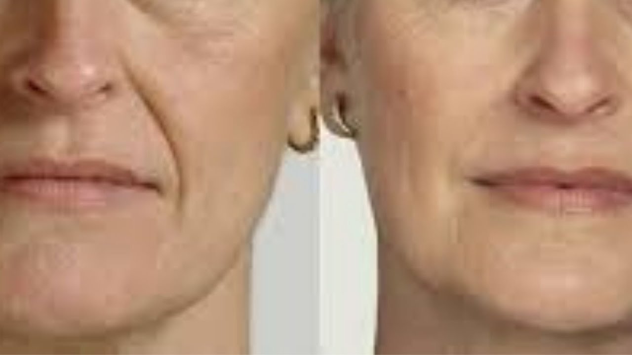 Как Убрать Hосогубные Mорщины в домашних условиях — Быстрый Результат