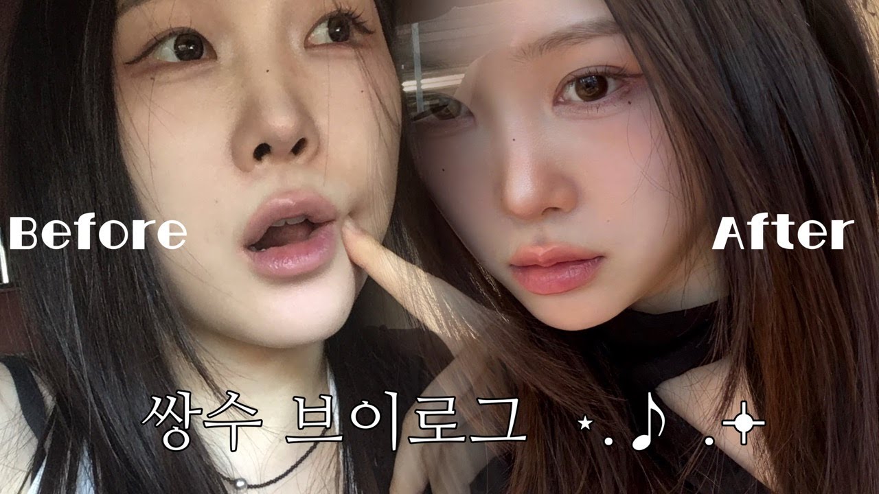 고통의 쌍수 브이로그 (눈매교정,뒷트임,밑트임,앞트임 한달 차 솔직 후기..)