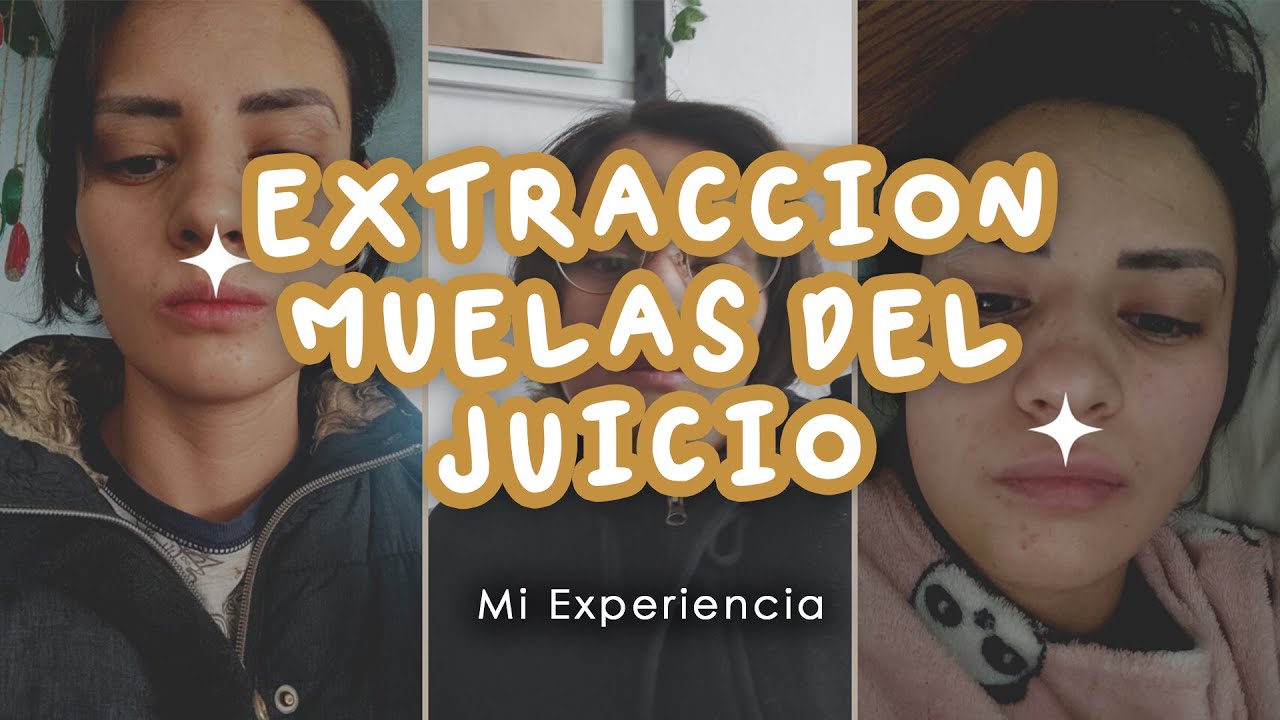 ME QUITARON LAS MUELAS DEL JUICIO!!! | MI EXPERIENCIA + TIPS