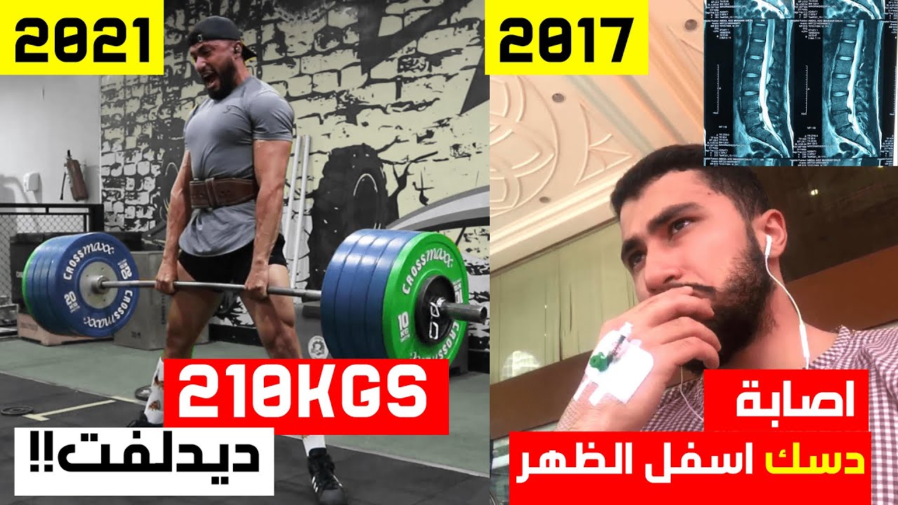 ديدلفت بعد اصابه انزلاق غضروفي | فلوق تمرين