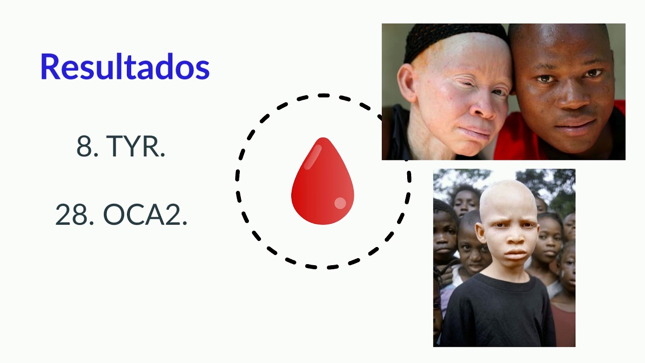 Albinismo oculocut&aacute;neo