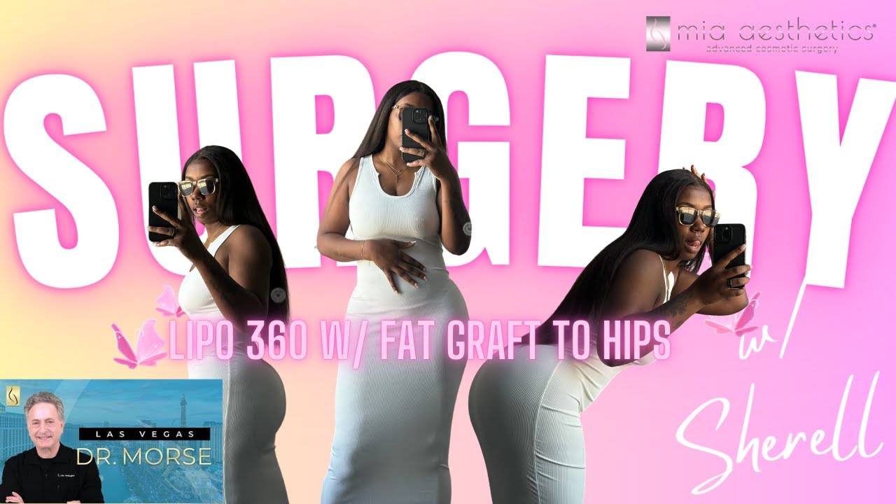 Surgery Story: Lipo 360 w/ Fat Grafting to the Hips