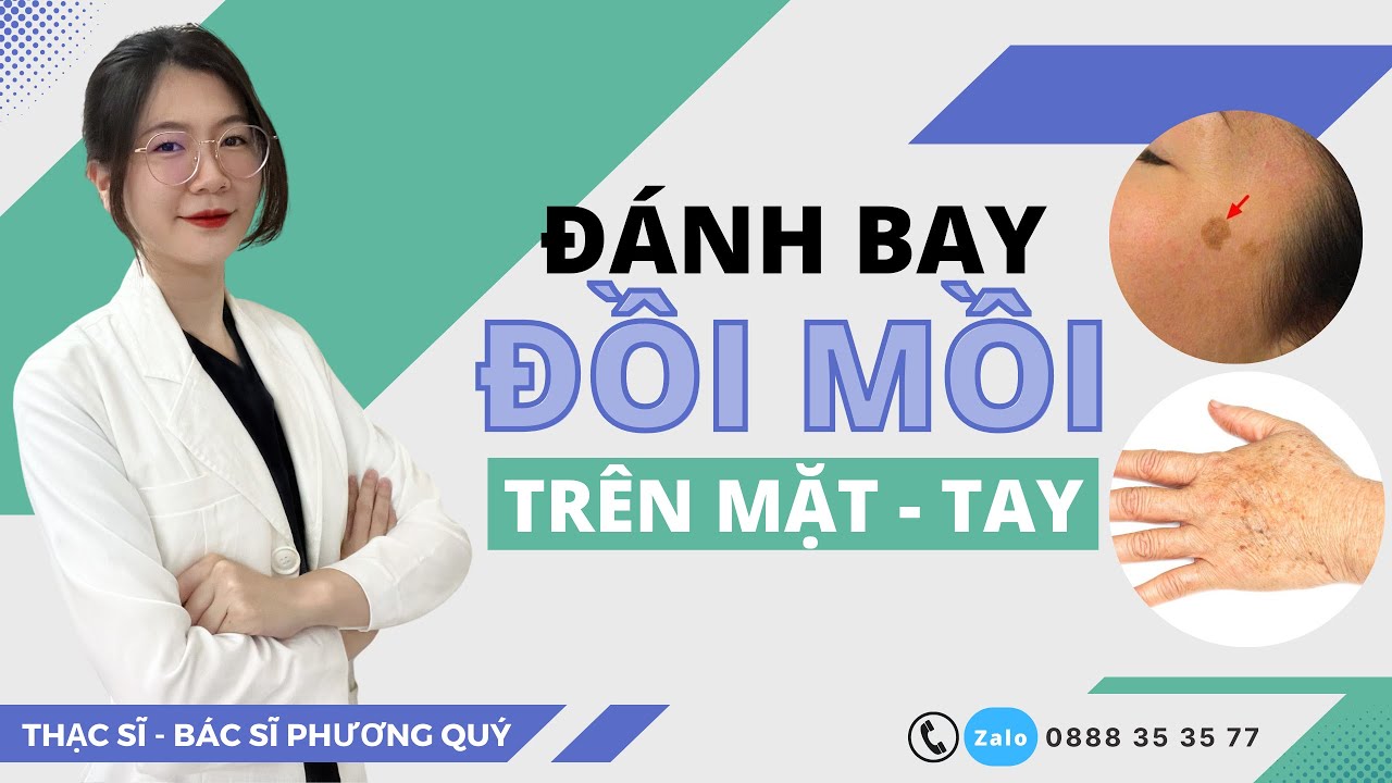 Cách trị ĐỒI MỒI trên mặt - tay | Phòng ngừa ĐỒI MỒI | Thạc sĩ - Bác sĩ Phương Quý