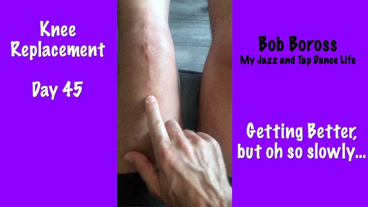 Bob Boross Knee Replacement Day 45 - Progress...But oh so slowly!
