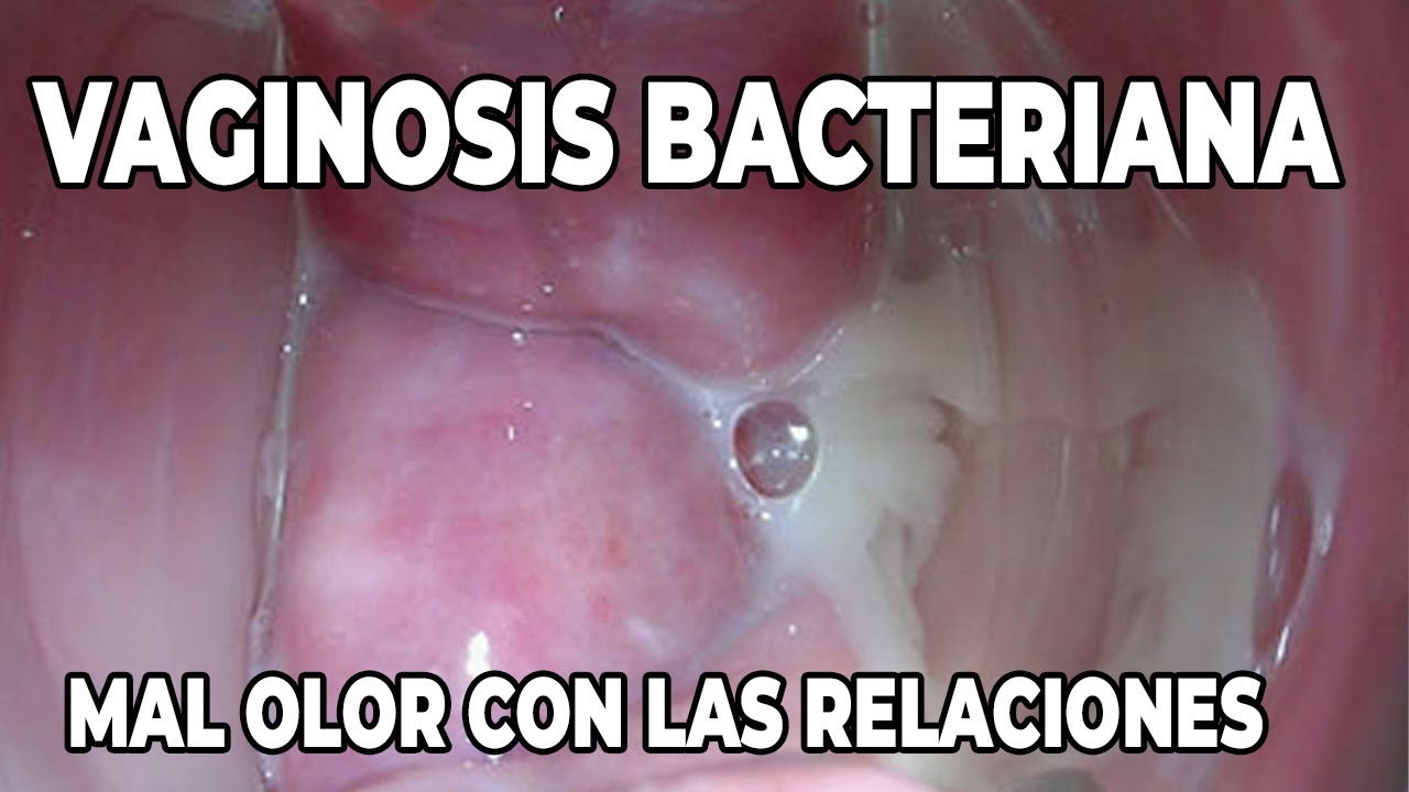 Como eliminar la VAGINOSIS BACTERIANA | Mal olor vaginal
