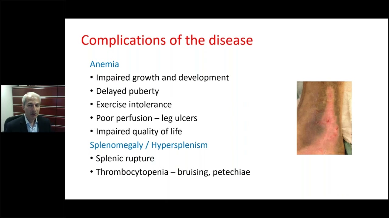 Complications of Thalassemia  Disease Effects and Treatment Effects