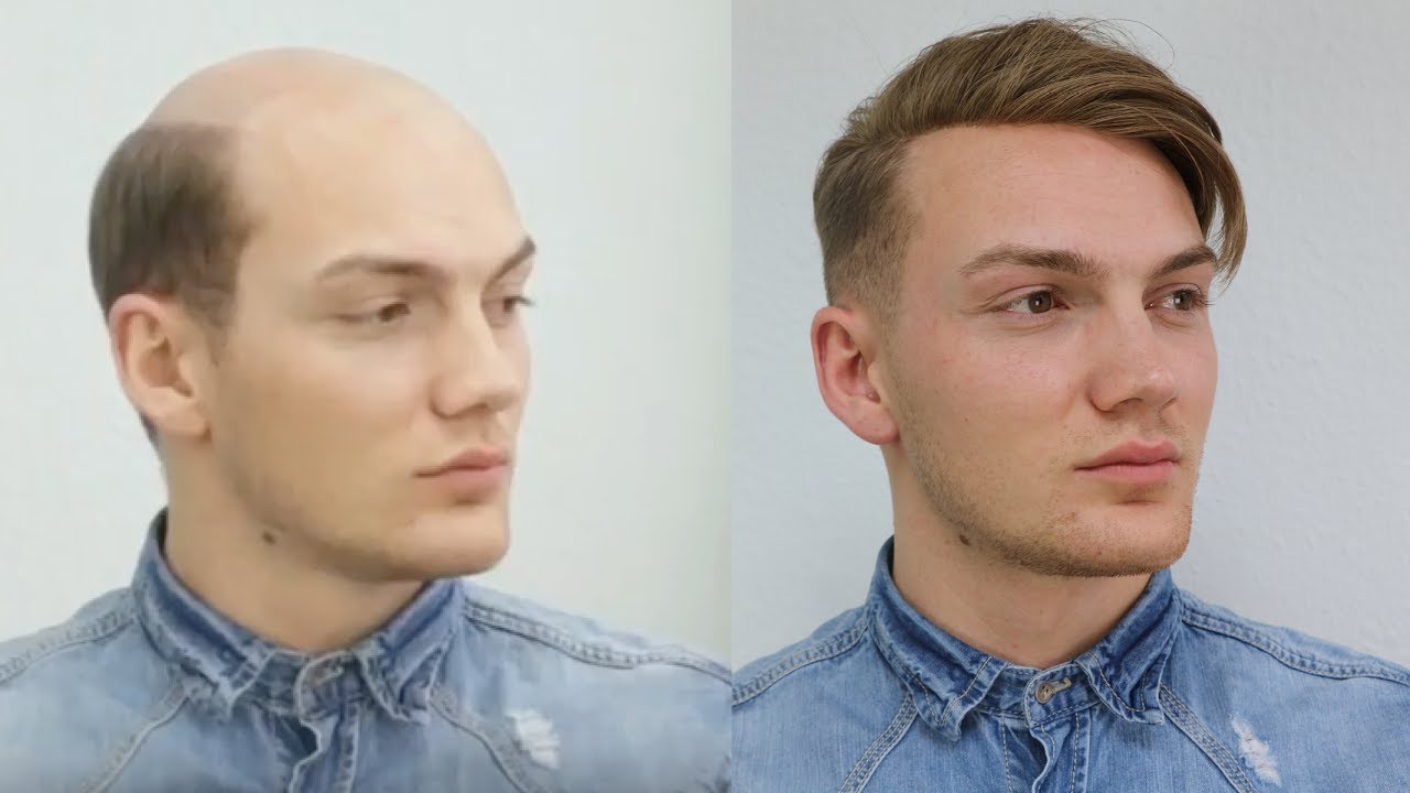 From Baldness to Trend Hairstyle 2017 / Non Surgical Hair Replacement for Men