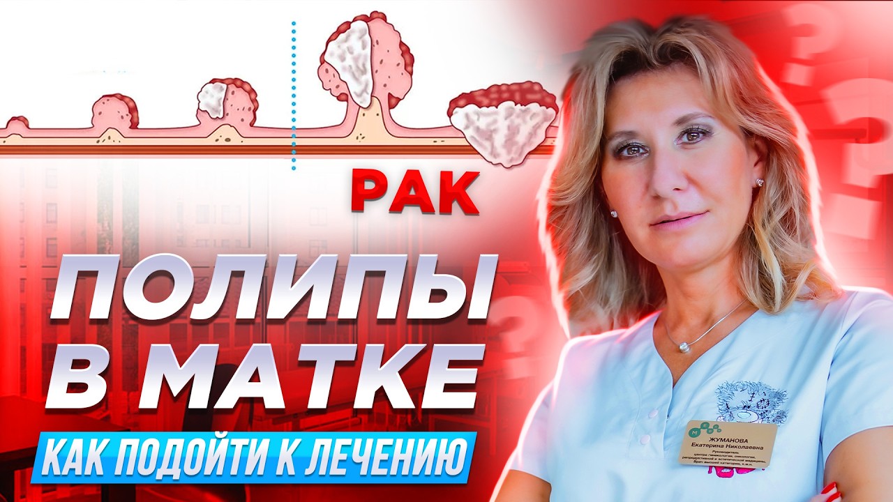 Полипы в матке: главные факты, которые важно знать каждой женщине