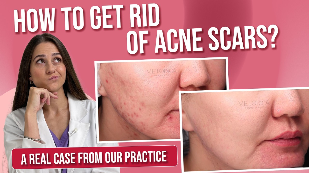 Scars after acne: best acne marks treatment