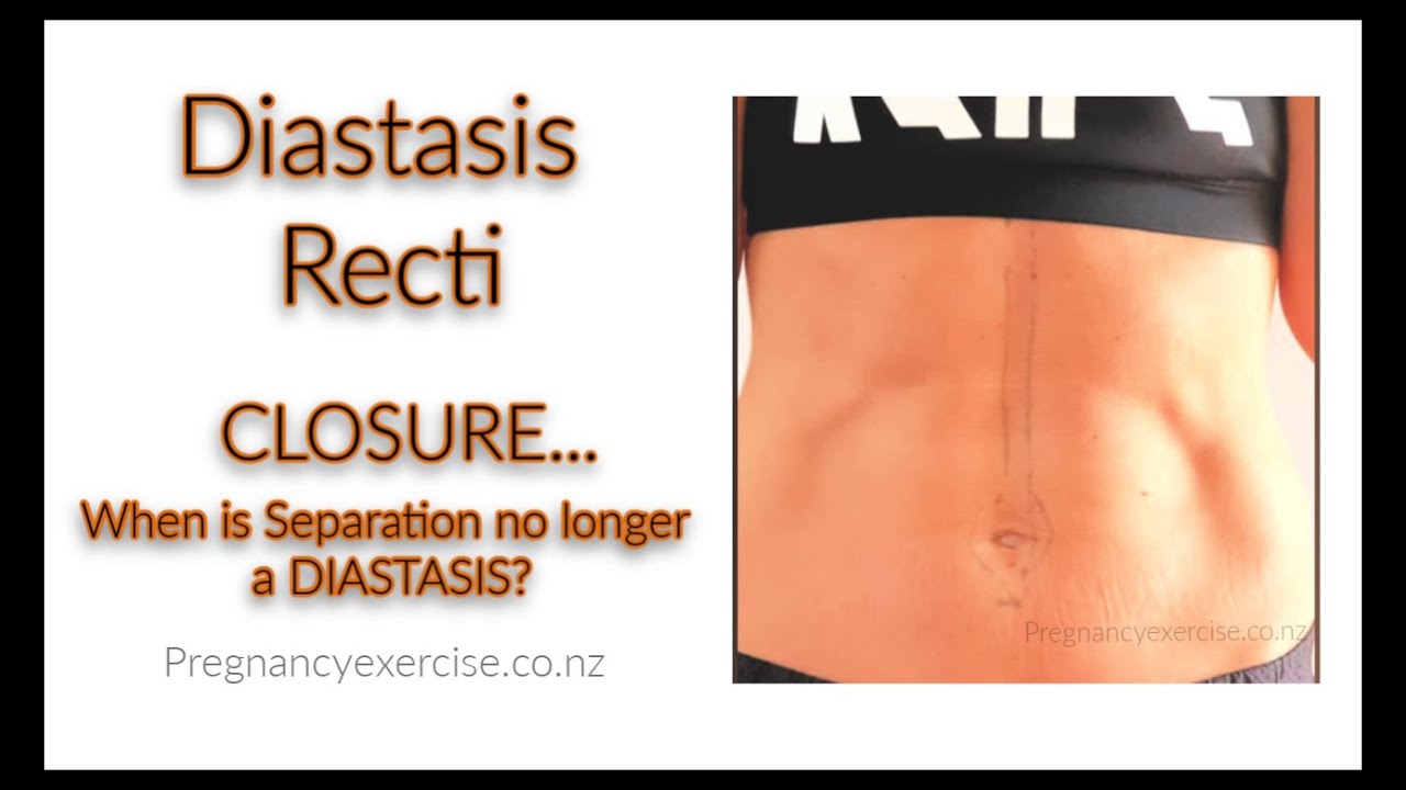 Diastasis Recti: CLOSURE...When is Separation no longer a DIASTASIS?