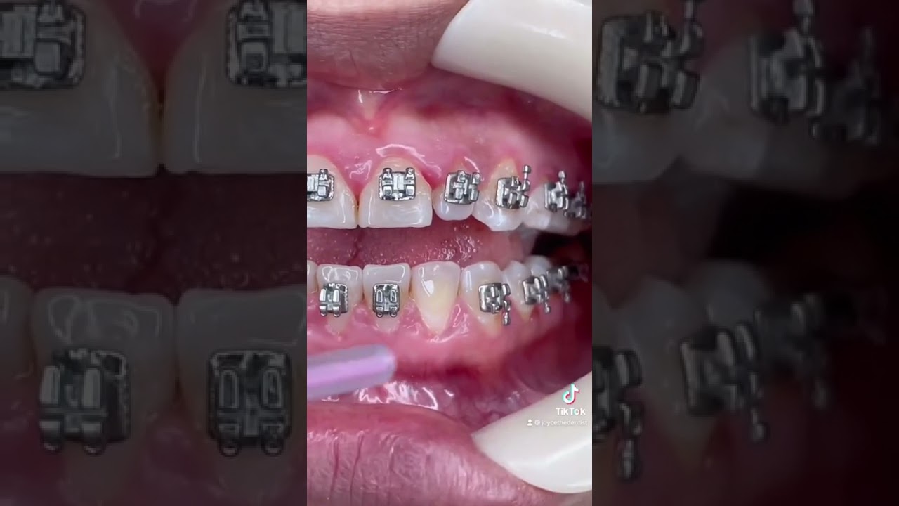 How Braces Brackets are Glued on - A dentist explains the steps #shorts #braces
