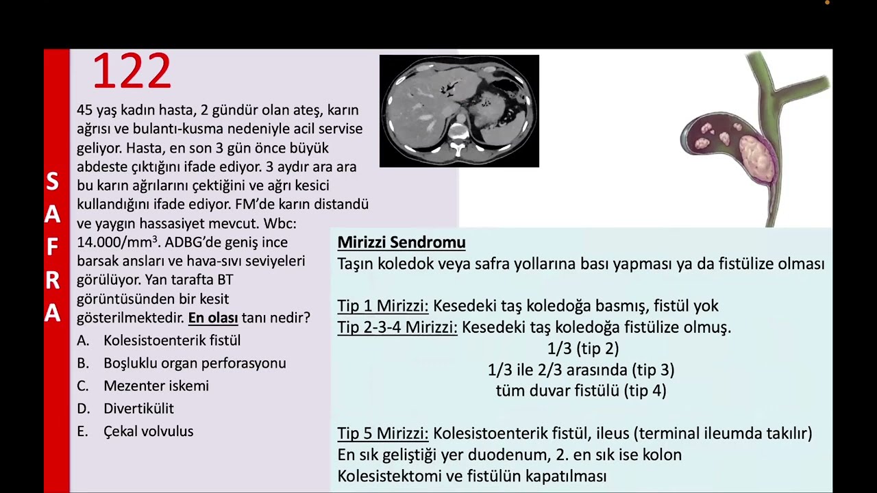 Mirizzi Sendromu Sorusu Referansımız “Soru Kampı”