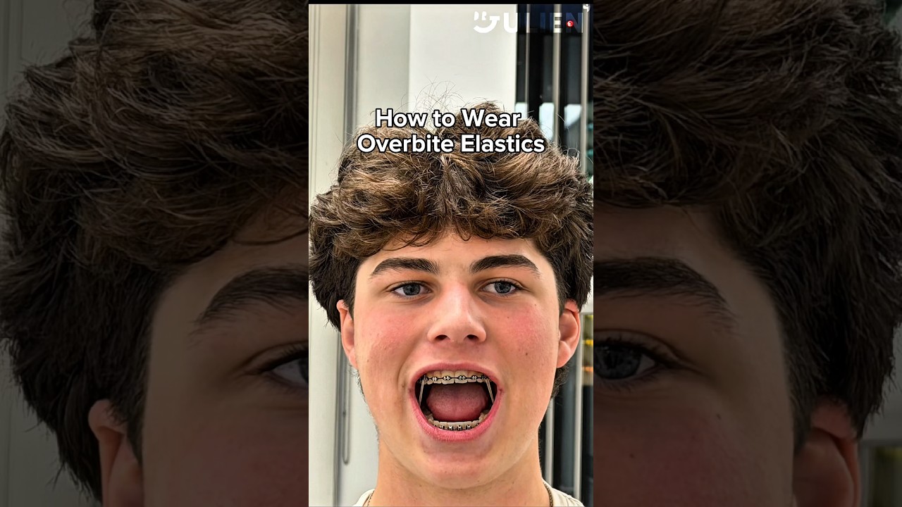 This is How You Wear Class 2 Overbite Elastics 