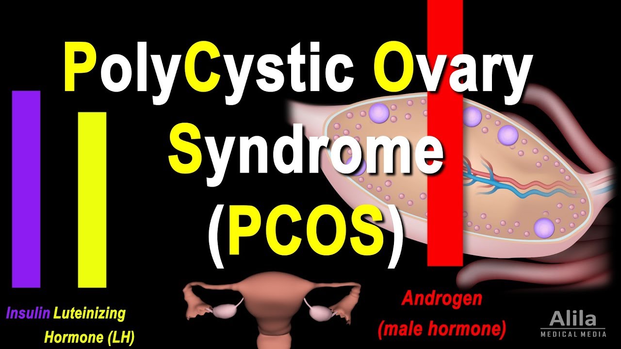 Синдром поликистозных яичников (СПКЯ): патология и лечение, анимация