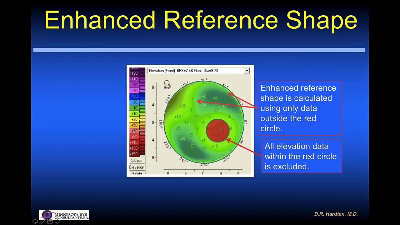 [Online Seminar] David R Hardten: Using OCULUS Pentacam&reg; for Total Refractive Surgery Practice
