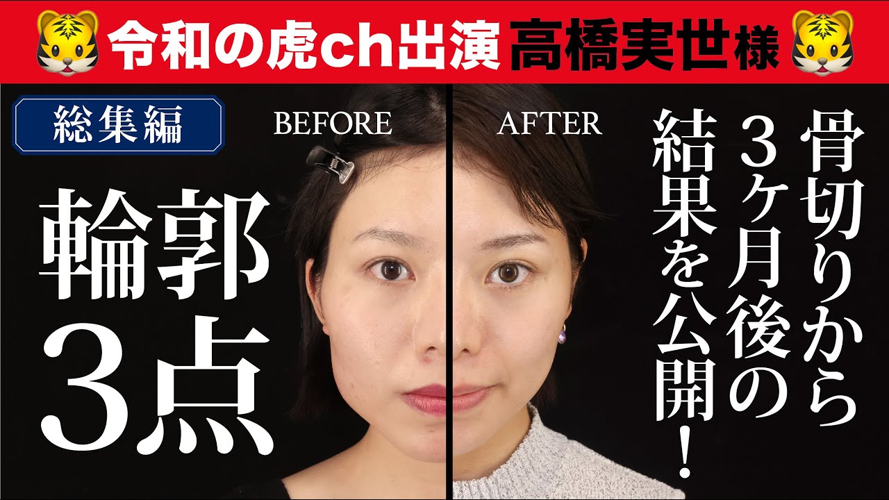 【美容整形版令和の虎】高橋実世様の生まれ変わった姿を公開！【術後3か月密着】