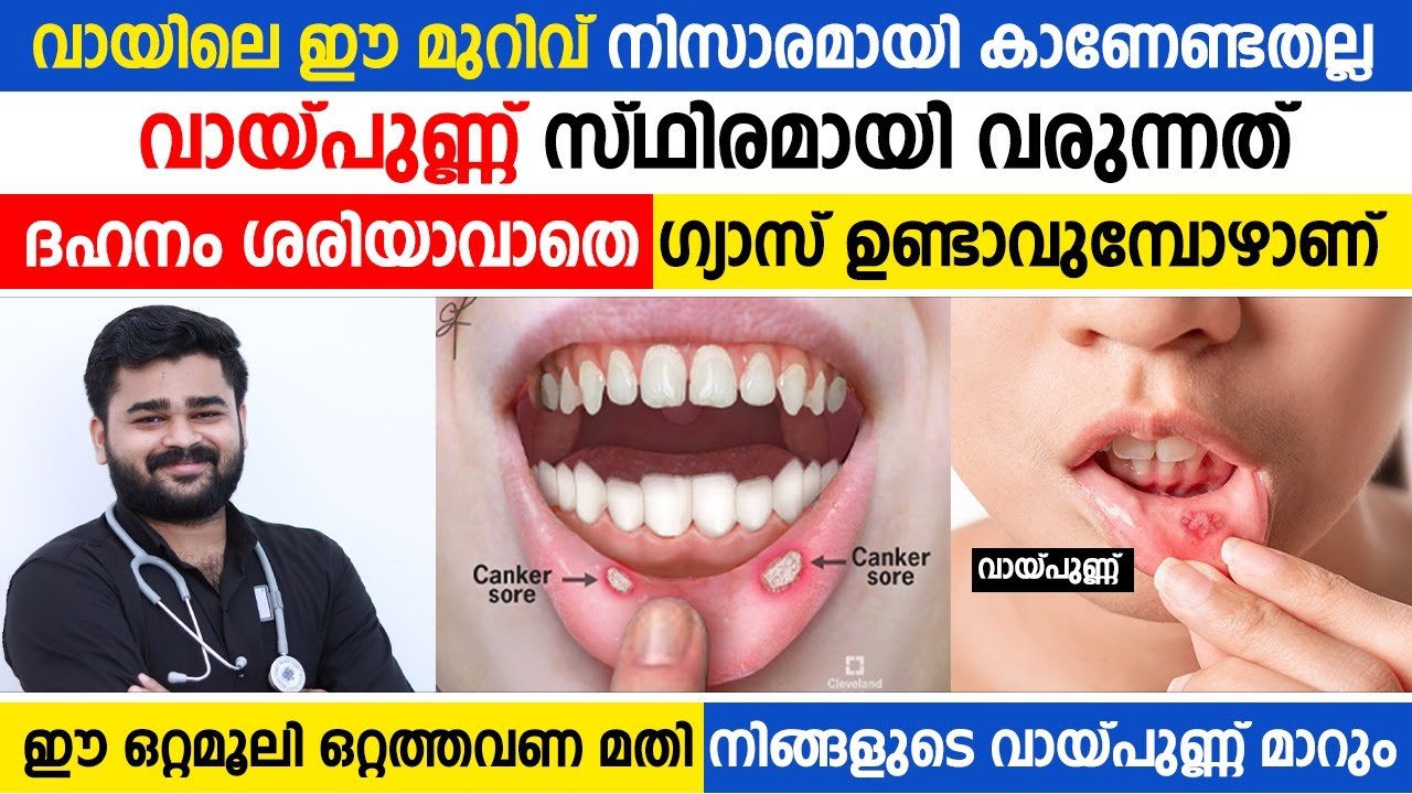 വായിൽപുണ്ണ് | സ്ഥിരമായി വരാൻ കാരണം ഇതൊക്കെയാണ് | ഈ ഒരൊറ്റമൂലി മതി വായ്പുണ്ണ് മാറാൻ