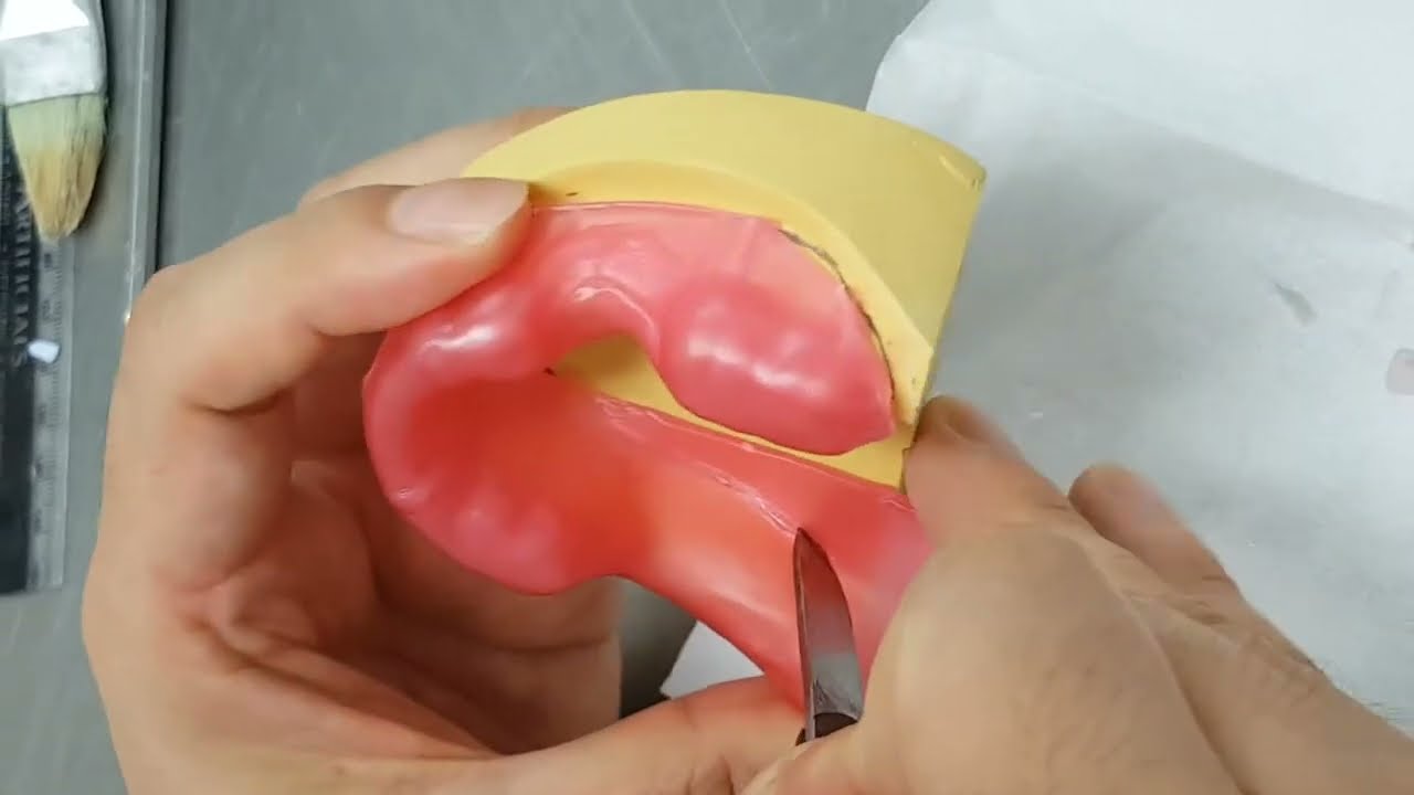 RPD special tray for mandibular