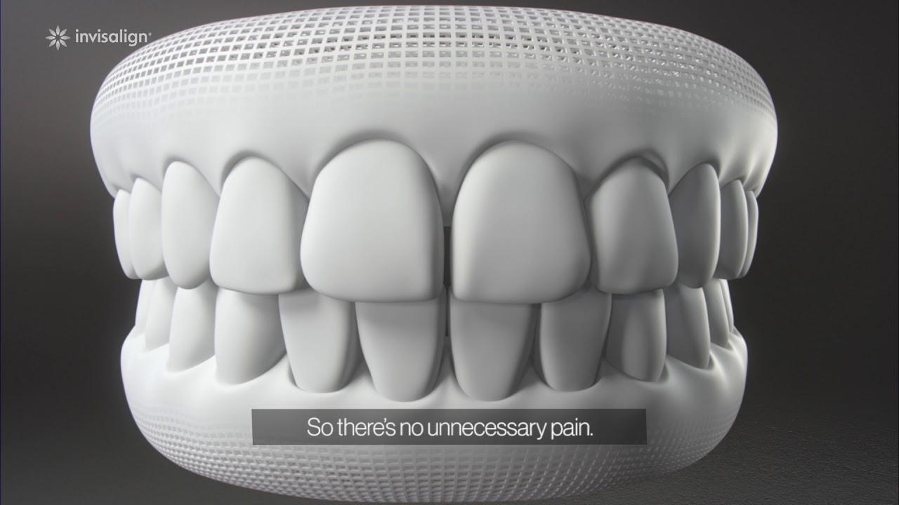How Invisalign Works