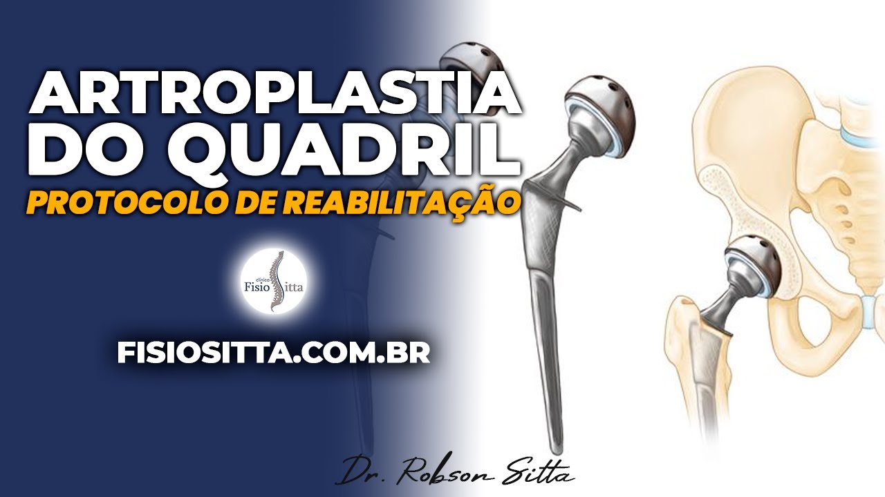 ARTROPLASTIA do QUADRIL PROTOCOLO de REABILITAÇÃO PROTESE Clínica de Fisioterapia Dr. Robson Sitta