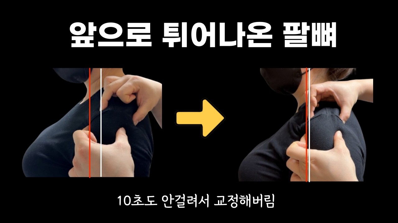 제발 속지 마세요 ‼️ 상완골 전방 활주 아닙니다 ‼️ 어깨충돌증후군 방문재활