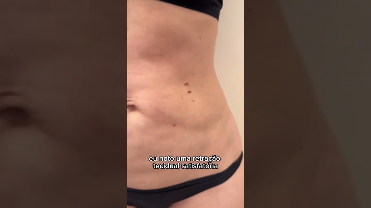 Correção Abdominal com Morpheus 8 - Resultados Surpreendentes