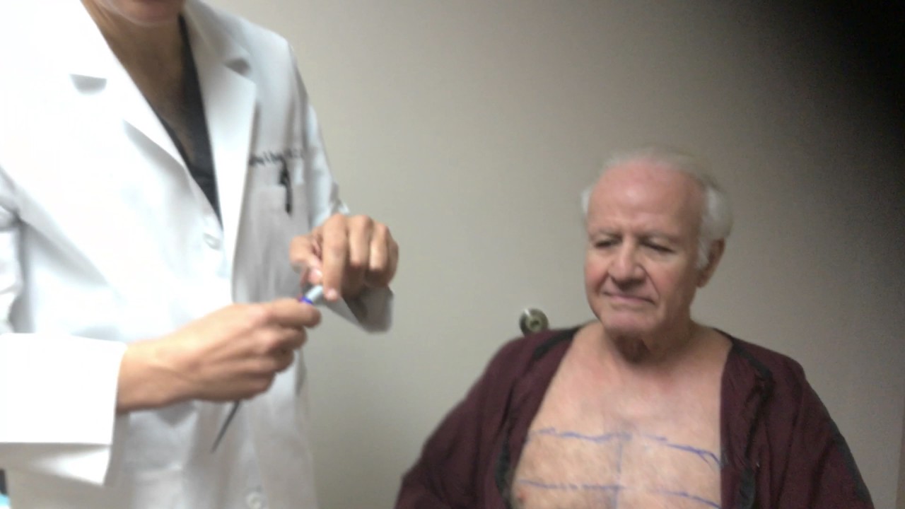 Body Hair Transplant (BHT) - Chest Hairs to Scalp | Dr. Jeffrey Epstein