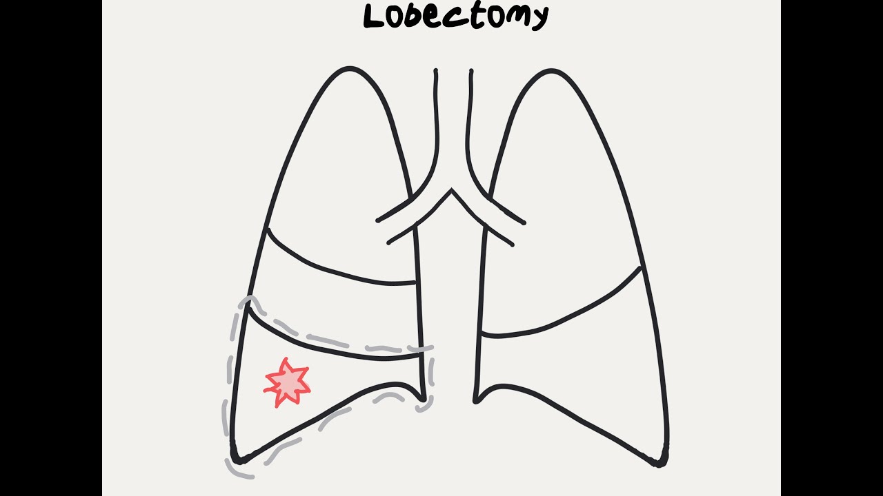 Doctor Explains Surgery Options for Lung Cancer