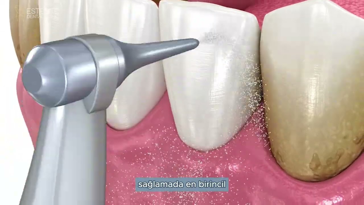 Diş Taşı Temizliği Neden Önemlidir?