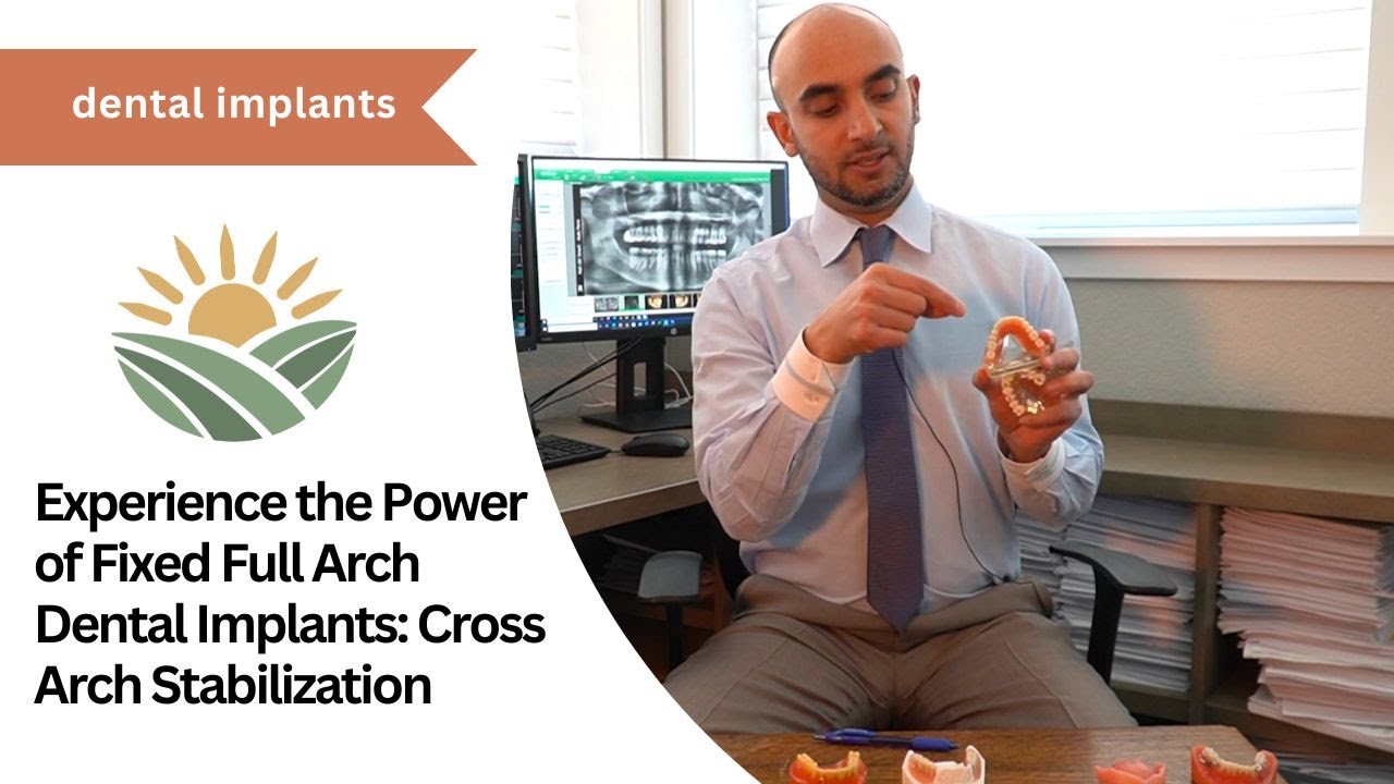 Experience the Power of Fixed Full Arch Dental Implants: Cross Arch Stabilization