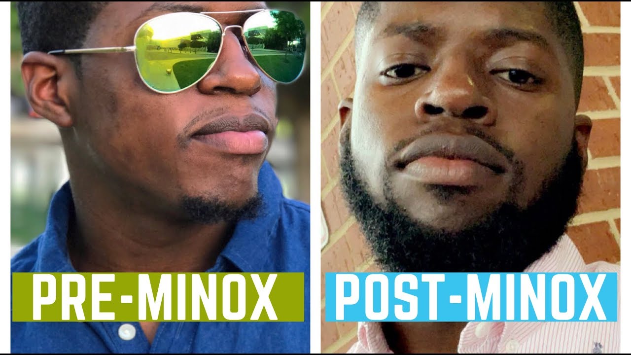 Minoxidil Beard Growth 1.5+ Year Progress/Review! + What’s Next For Me?