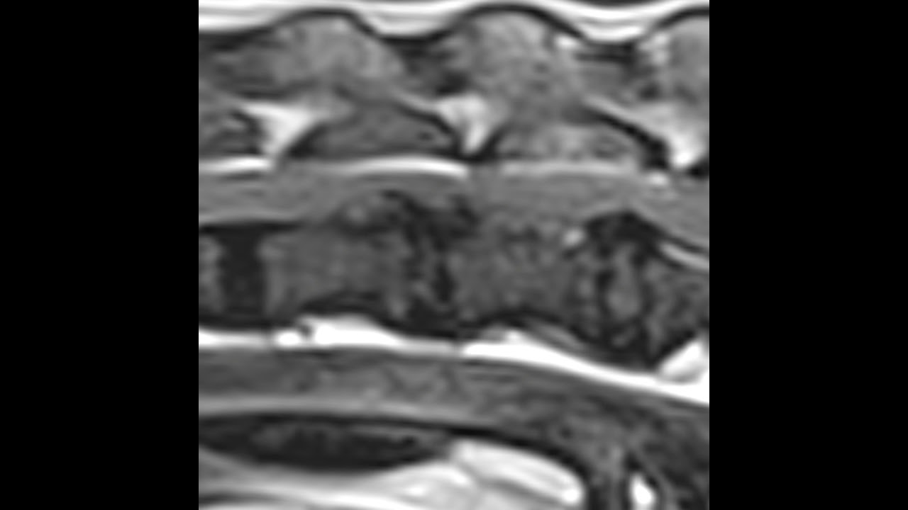 Prophylactic fenestration of intervertebral discs in chondrodystrophic dogs with follow up MRI