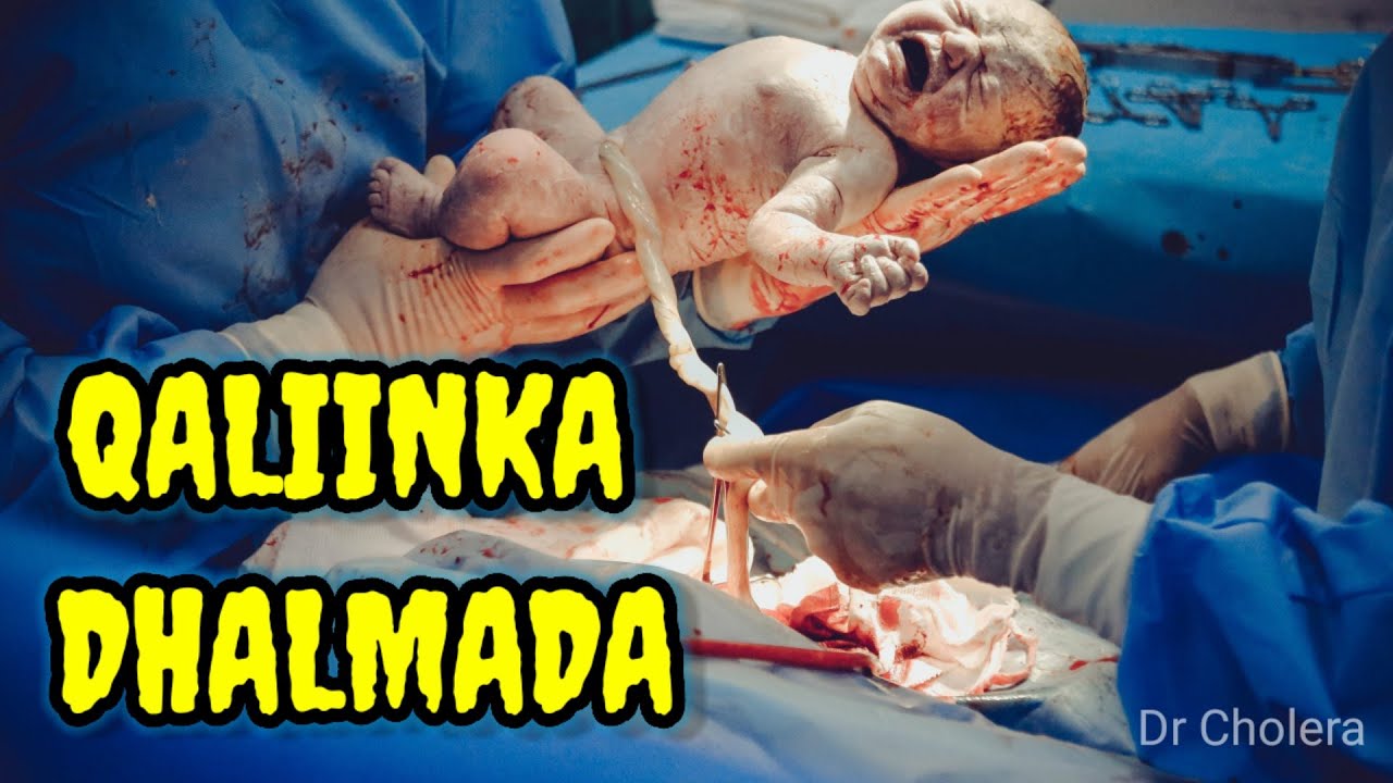 QALIINKA DHALMADA || C SECTION || MAXAA LOO SAMEEYAA || DR CHOLERA TUBE 2022