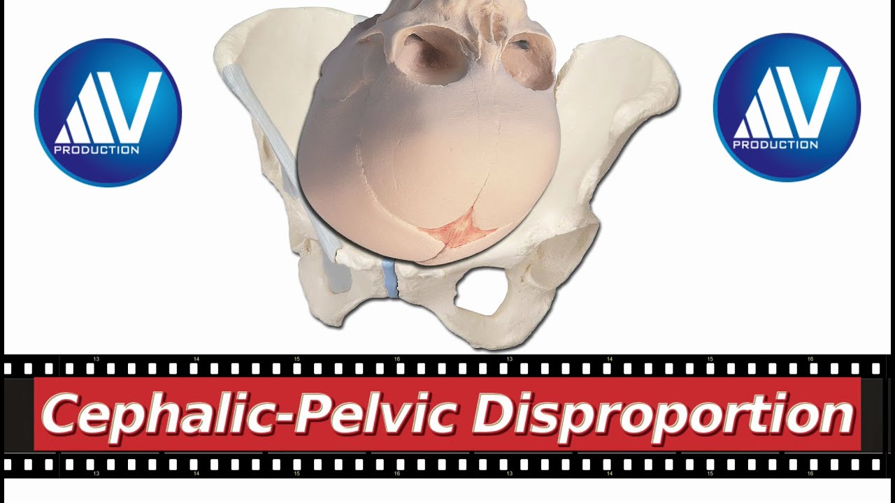 Contracted Pelvis Part I