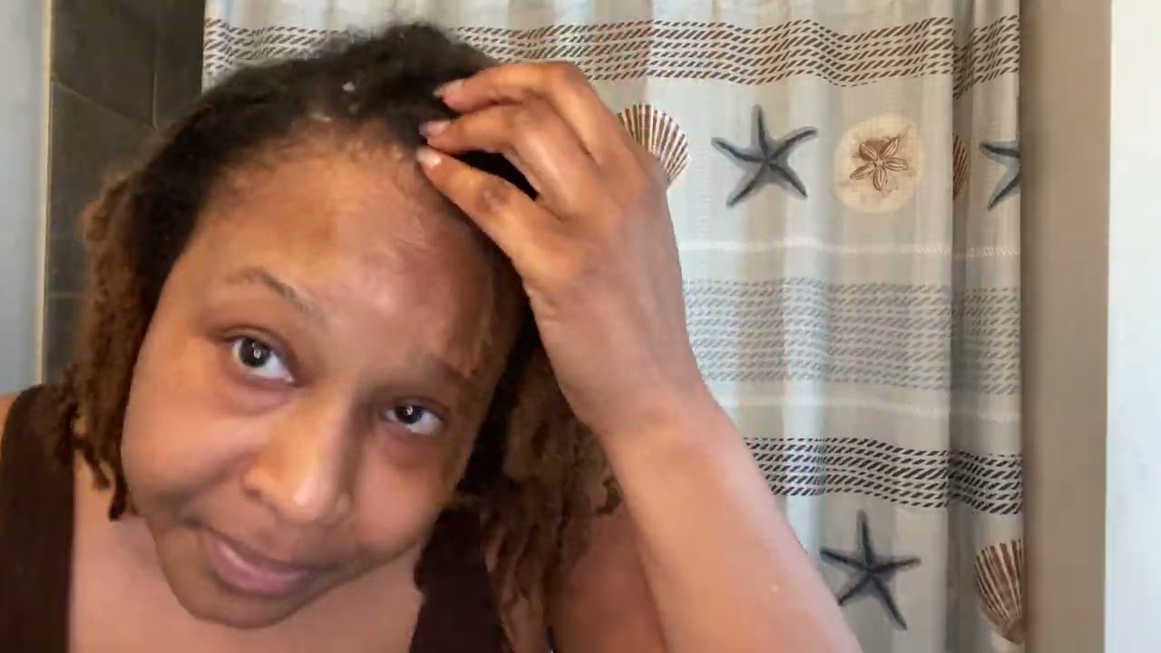 Seborrheic Dermatitis and Locs!!!!!!