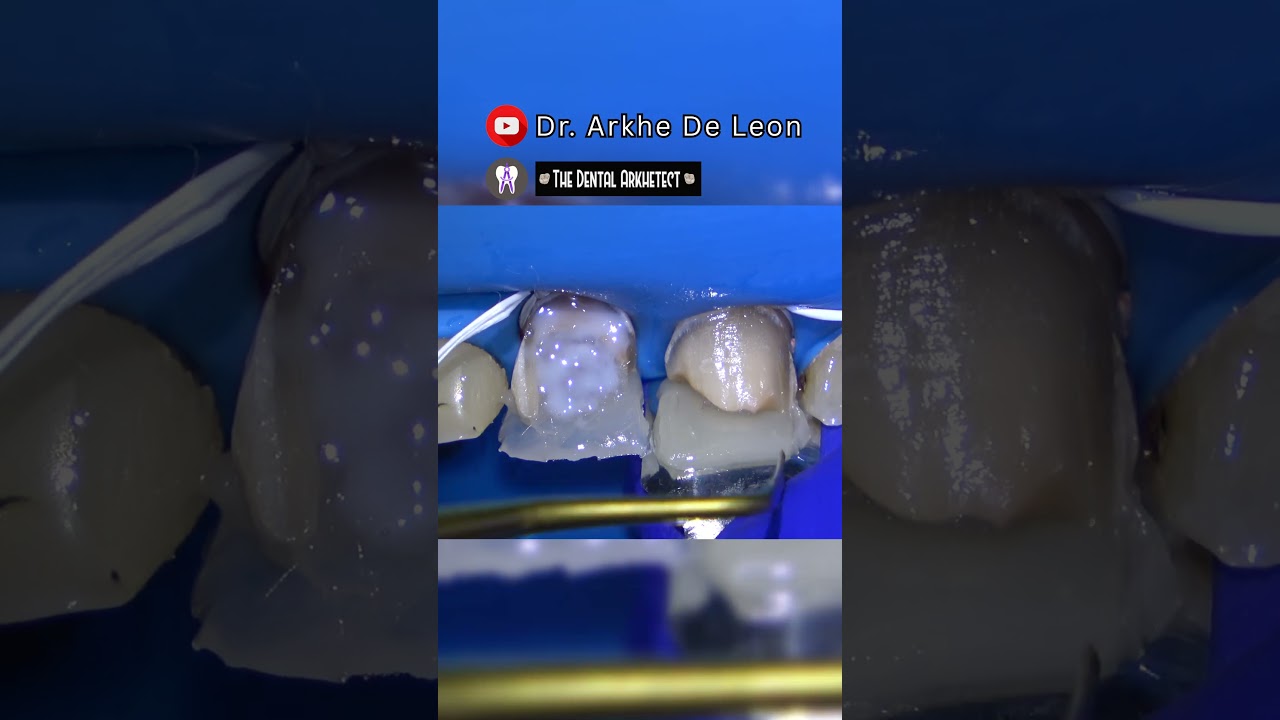 SIMPLE RESTORATION OF A ROOT CANAL TREATED TEETH (PART 1) #4k   #dentist #C82