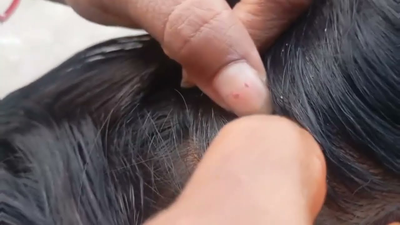 More lice removal real vIog #and #diyhairstyle #longhair #pls #ytshort #viral #haircare #homemade 