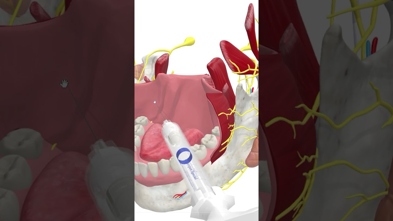 Inferior Alveolar Nerve Block #dentalanatomy #dentist #dental #dentalanesthesia